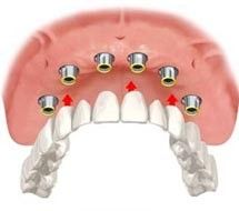 Foto 2 de Dentadente®-Medicina Dentária
